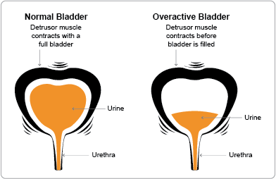 Overactive Bladder Never Allows the Bladder to Fill Completely