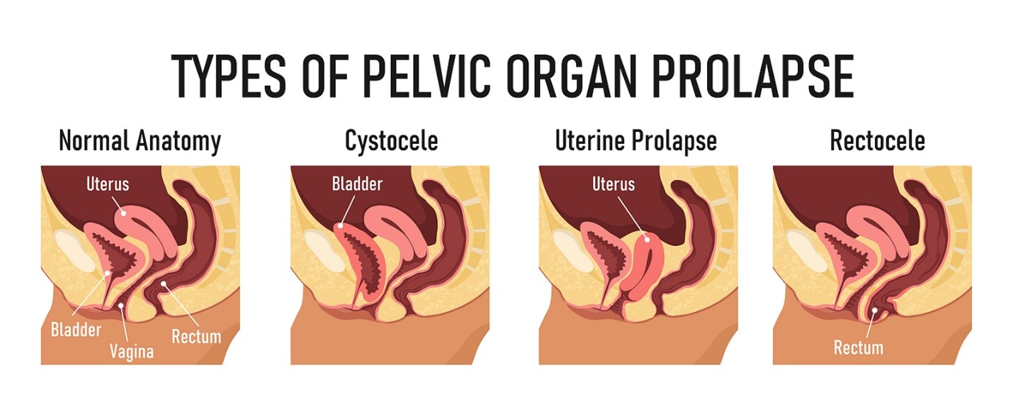 There Are a Few Types of Pelvic Organ Prolapse