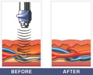 Shock Waves Penetrate the Skin to Stimulate Growth in the Blood Vessels