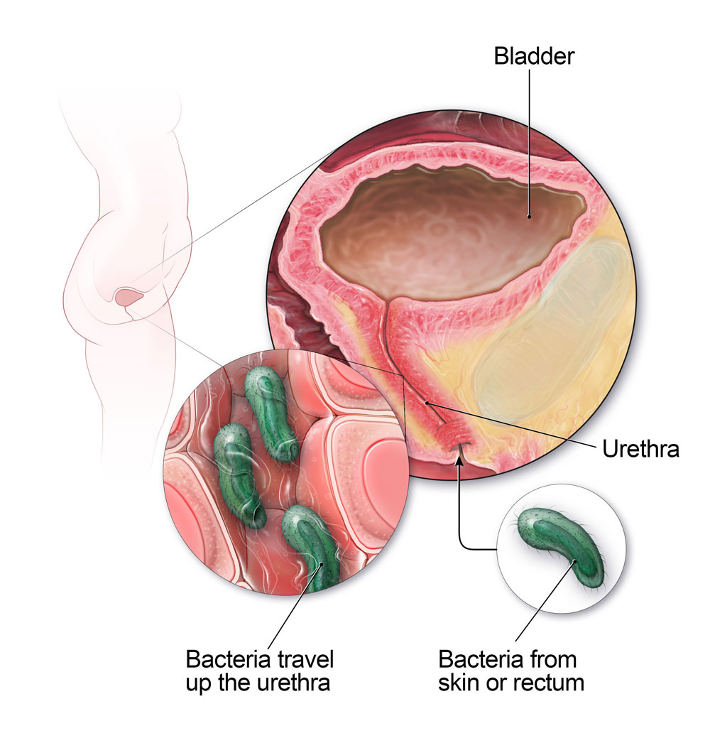 UTIs Occur When Bacteria Travel Up the Urethra