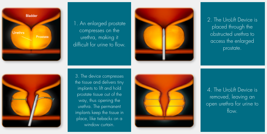 How the Urolift Procedure Expands the Urethra