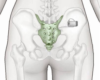 The Axonics/Interstim Device Mounts Comfortably Near Your Hip