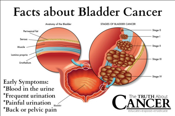 The Progressive Stages Of Bladder Cancer