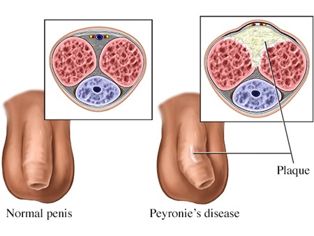 Scar tissue Builds Up in the Penis Which Makes it Inflexible in Some Areas