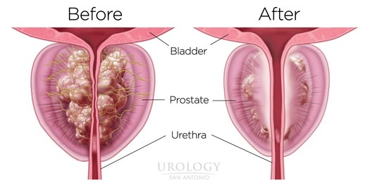 Prostate gland Before/After Rezum