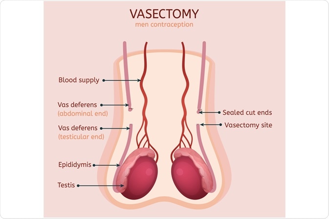 A Vasectomy Divides the Vas Deferens and Prevents Passage of Sperm