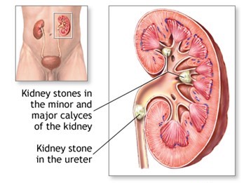 Kidney Stones are Crystallized Blockages in the Urinary Tract